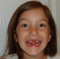 Missing Tooth Missing Tooth
